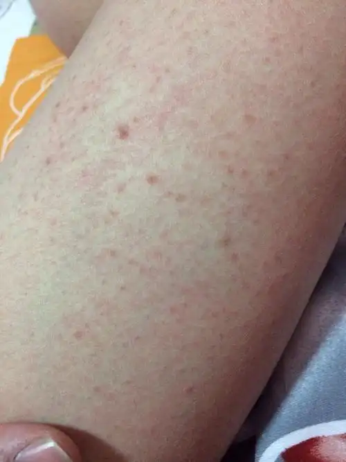 大腿上起的红疙瘩