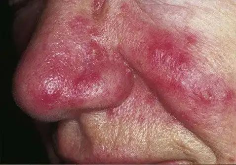 皮肤病图片对照查看图片大全-酒渣鼻症状图片