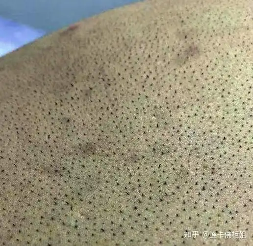 我想知道去黑头最有效的解决办法是什么我脸上的黑头毛孔都要难看死了