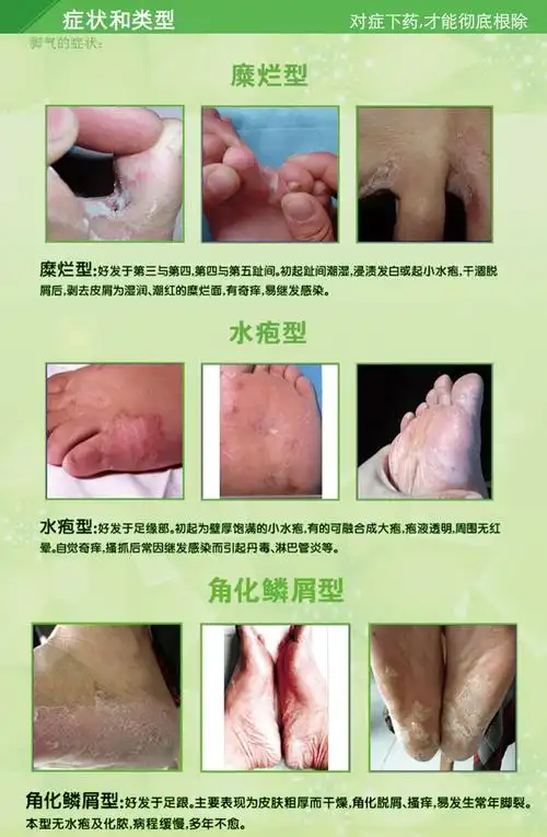 去脚臭治脚气止痒香港脚丫特效糜烂脱皮药水泡祛除脚气膏喷剂雾王