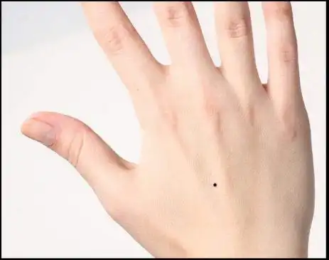 手臂有痣详解左右手臂有痣解说