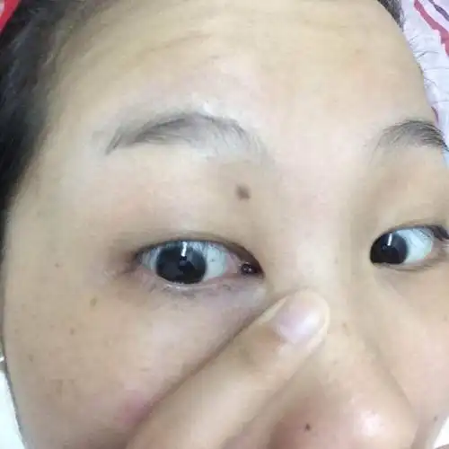 泪阜上长了个黑痣,能帮忙看下吗