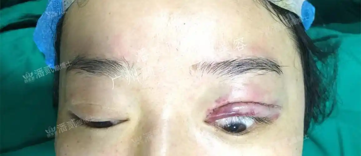 提肌上睑下垂失败后留阴影,梦中惊醒,开灯照镜,才发现是虚惊