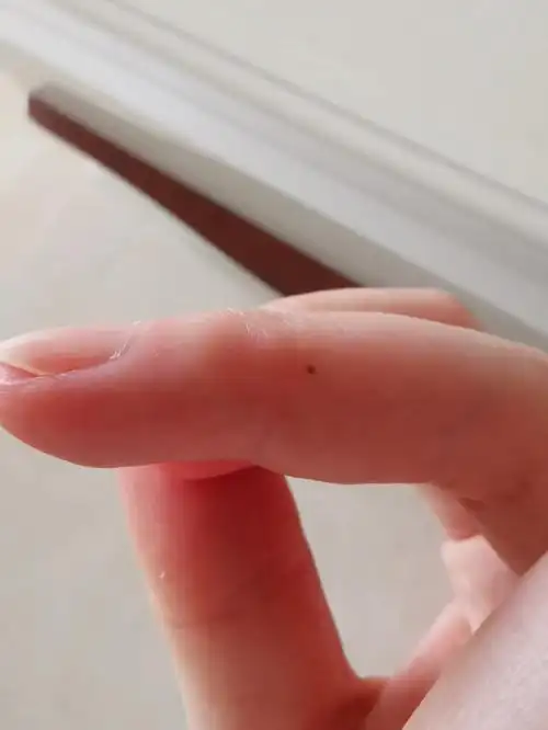 左手中指突然长了一颗痣还变大了