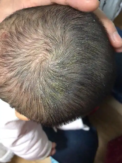 头皮脂溢性皮炎的症状(头皮脂溢性皮炎怎么治才能断根)