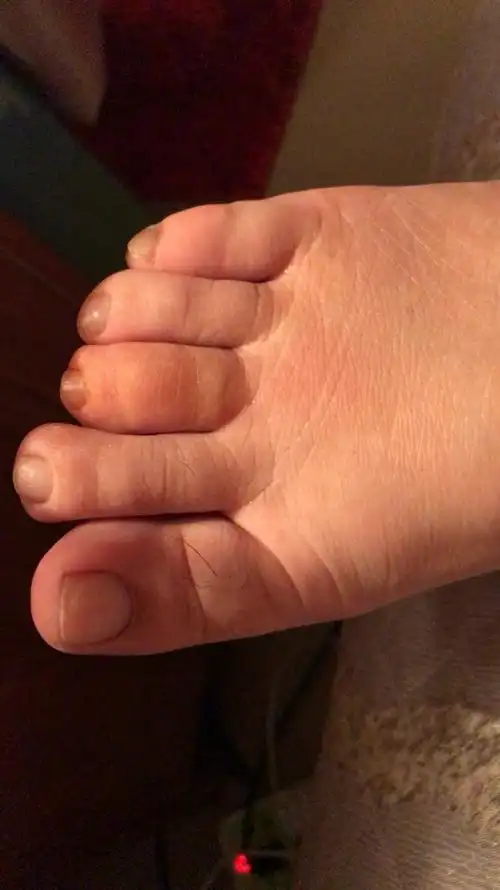 我女朋友的脚中指莫名其妙的红肿了