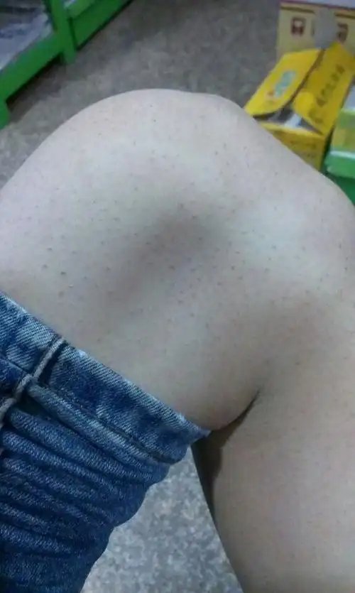 腿上的毛孔堵住,抠出来是毛.