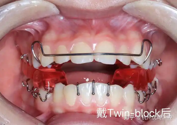 12岁小女孩手法复位 佩戴twin block前后变化 - 知乎