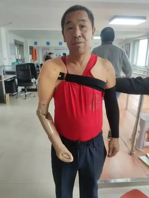 上肢假肢的真实案例