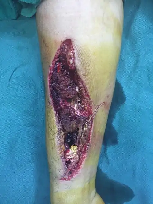 右前臂开放性损伤,伤口污染,挫伤重,一期给予清创,vsd伤口覆盖.