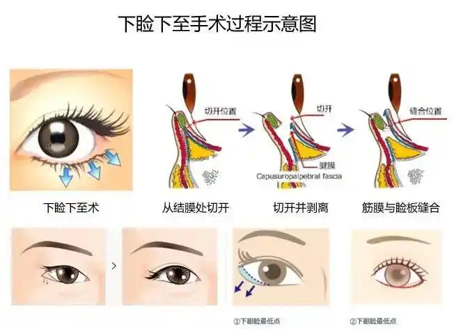 【手术方法】在结膜处切开,人为地让下眼睑向下退缩,最后缝合.