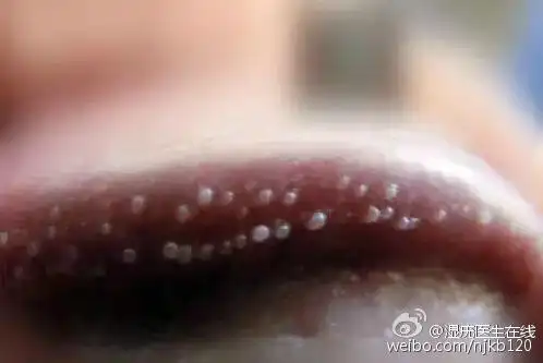 男性珍珠状丘疹和尖锐湿疣不同它与