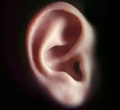 小耳朵畸形会遗传吗?为什么孩子会出现小耳朵畸形?