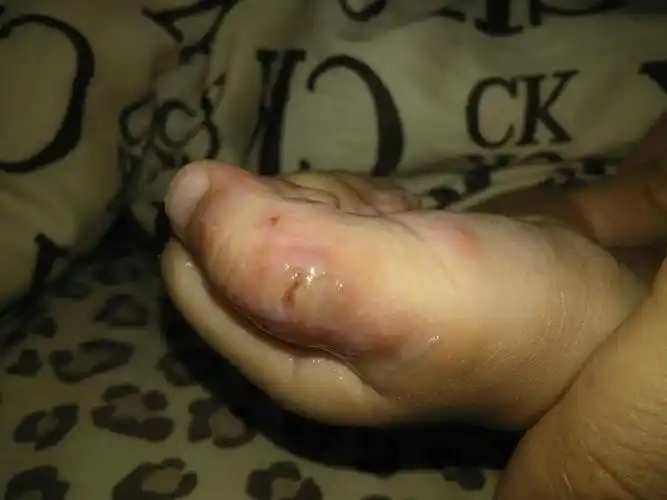 宝宝吃手 现在发炎了周围还有小水泡 拜托大家帮帮忙啊 去了医院医生