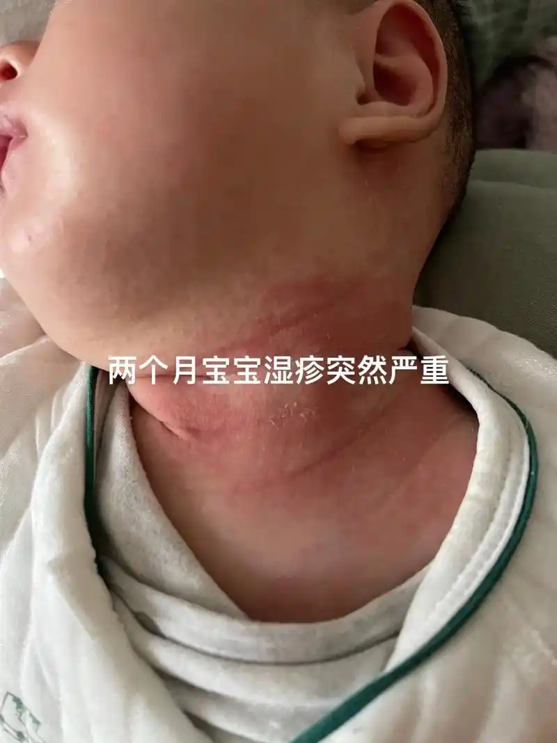宝宝湿疹 只有经历过的宝妈才知道#新生儿湿疹 有多顽固. - 抖音