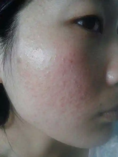 人难受不安的脸上发红发痒的问题,初步缓解人的过敏痛苦想要镇定皮肤