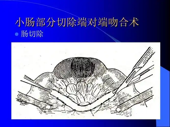 小肠部分切除端对端吻合术ppt