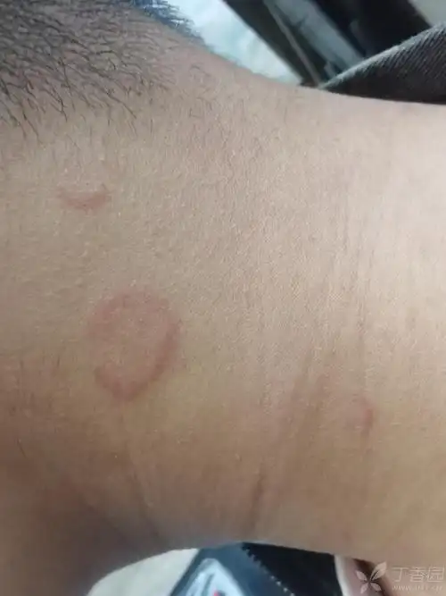 请教老师们,这种皮疹应该诊断什么? [病例帖]