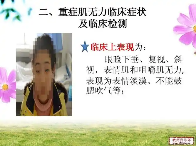 重症肌无力综述ppt