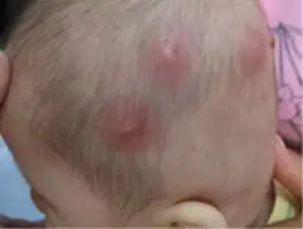 毛囊炎_治疗_症状_鉴别_毛囊炎专家免费咨询_快速问医生