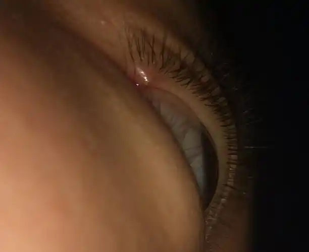 眼睛上眼睑起了一个小痘痘怎么办?