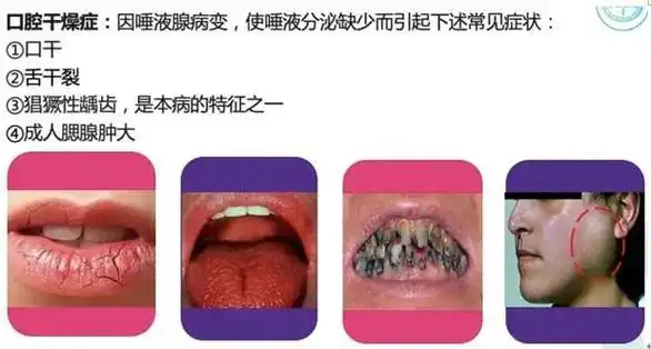 科普丨你知道什么是干燥综合征