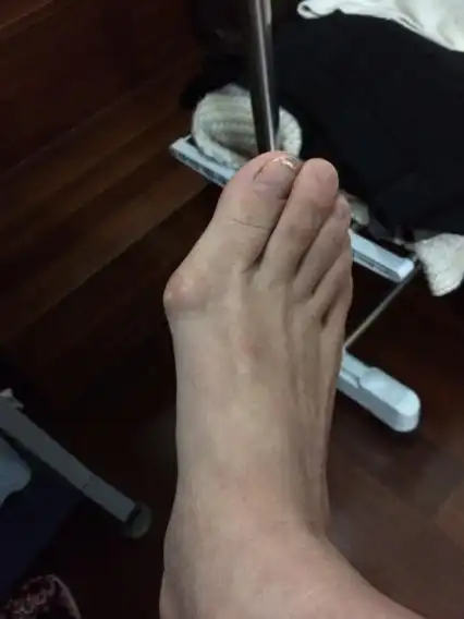 长了这样的一个突出骨头.是不是叫脚趾外翻.