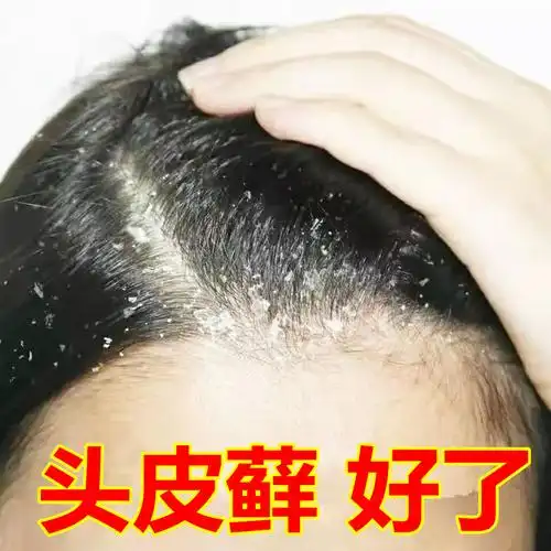 头皮藓药-特价促销-优惠券领取-价格|多少钱|什么牌子好-35优惠券网站