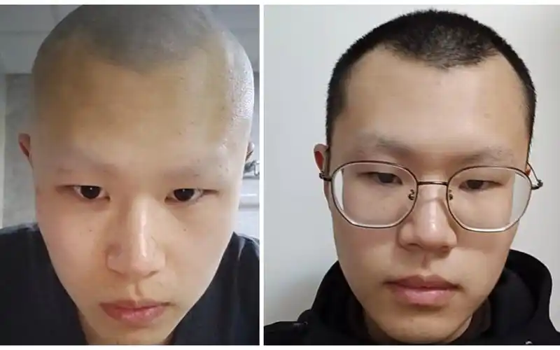 剃光头发眉毛的第二十天,咋一看似乎没什么问题了