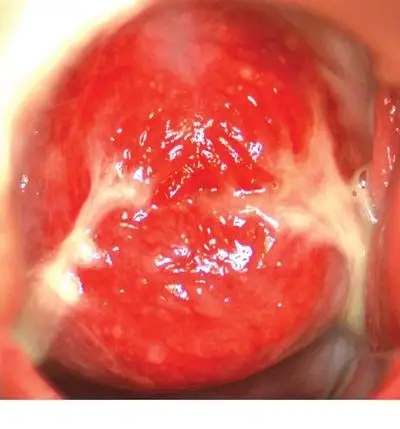 宫颈癌图片 (32)