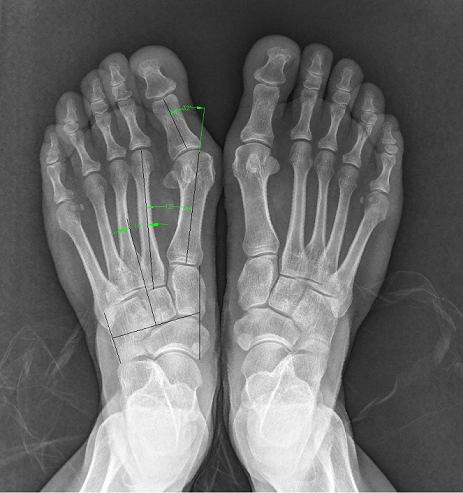 对于重度拇外翻(拇外翻角大于40°,第1,2跖骨间夹角大于20°),除常规