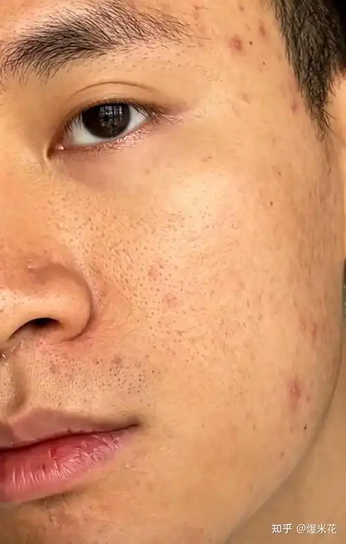 男生毛孔粗大,黑头多,出油长痘怎么办?