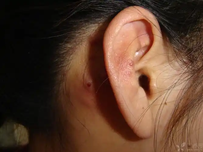 【病例讨论】门诊病历 耳部结节