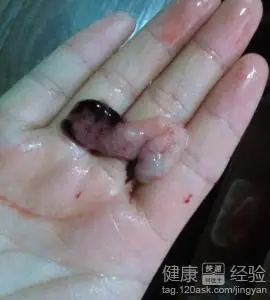 43天药流排出孕囊图片 - 搜狗图片搜索