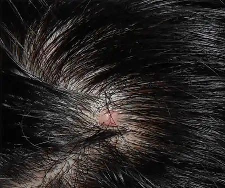 【头上长红疙瘩什么原因图片】头上起疙瘩怎么回事_头上长痘痘是什么