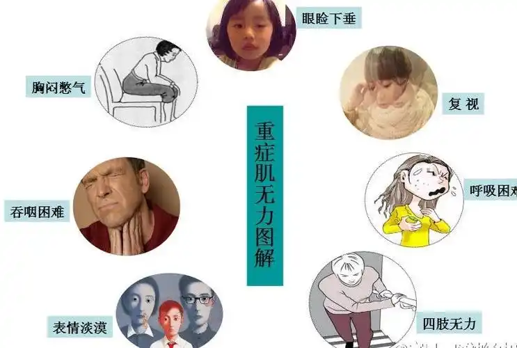 专治重症肌无力的医院