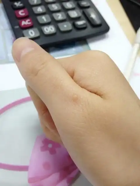 手上长了一颗东西,像痣,但是不是黑色的,有点类似肉色的,在大拇指底部