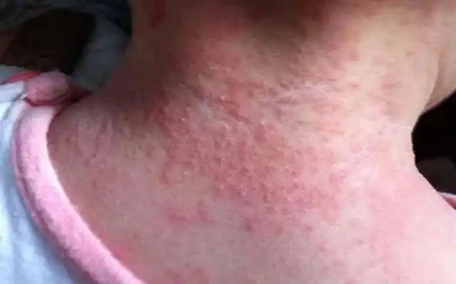 张家纲小儿推拿:夏日炎炎,宝宝再难缠的痱子也能轻松解决啦