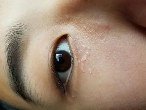 好几年了,不痛不痒没感觉,请问这是什么东西,是不是脂肪粒啊,我几年来