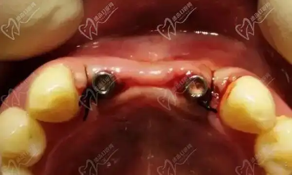种植牙失败图片