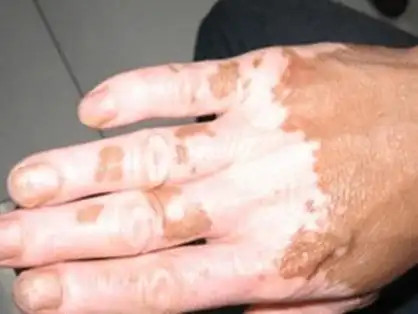 长沙鸿业皮肤病专科医院唐茂雄主任浅谈:白斑恢复时期,患者需要做好这