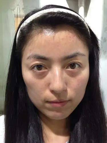 以前老长时间玩手机,现在皮肤变差了,有什么简单的办法可以治么?