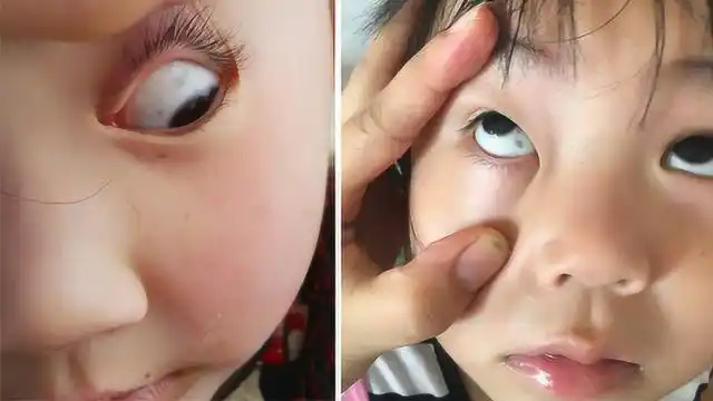 宝宝眼白上有不明黑斑吓坏爸妈 可能是这两种情况