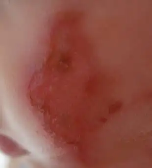 14个月宝宝开水烫伤,医生开了美宝,现在创面如图片所示,请问还需要