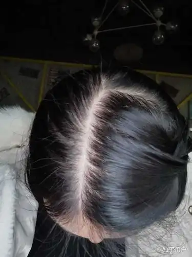 女生头顶头发少是什么体验 ?