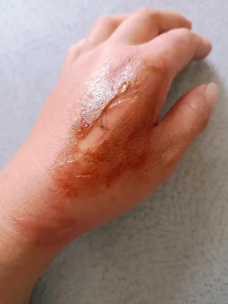 一不小心手被烫伤了,成年人的世界里没有容易二字,也没有矫情, - 抖音