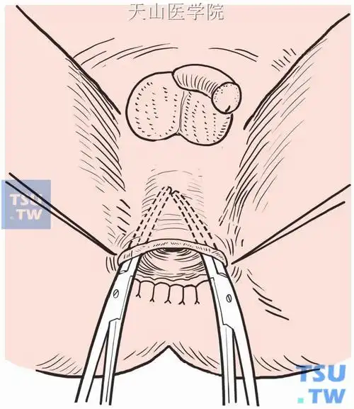 duhamel结直肠切除和直肠后结肠肛管吻合术