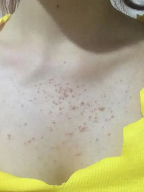 胸前起了一片类似粉刺的小红痘痘,里面像是有白头之类的东西,,_毛囊炎