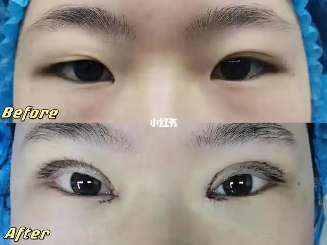 全切双眼皮前后对比_全切双眼皮_双眼皮手术_双眼皮_内眼角_成都双