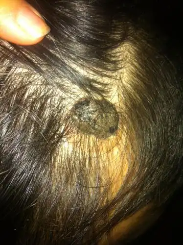 前几年头上突然长了个跟肉痣一样的东西不